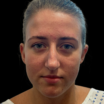 preservation-rhinoplasty-before